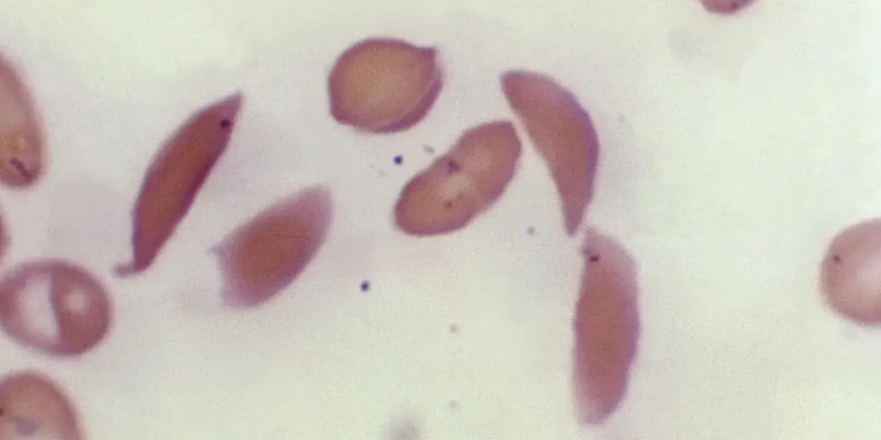 Sickle cell gene therapies offer new hope, accessing them is hard
