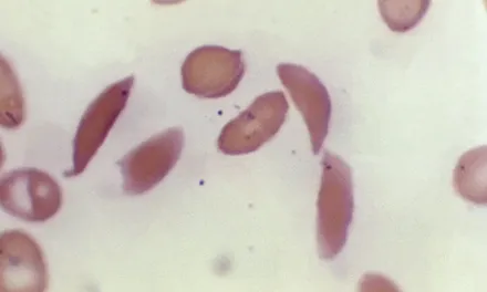 Sickle cell gene therapies offer new hope, accessing them is hard